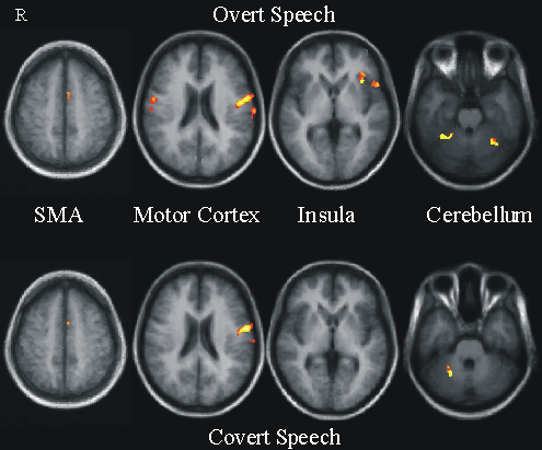 fMRT-Aufnahme, lautes und inneres Sprechen